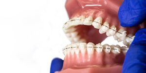 Formlabs Dental braces 3DHUBgr